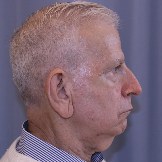 Neck Lift Before and After 01