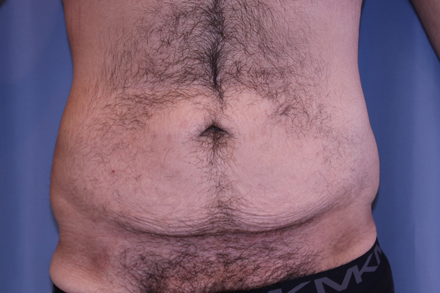 Tummy Tuck Before and After 01