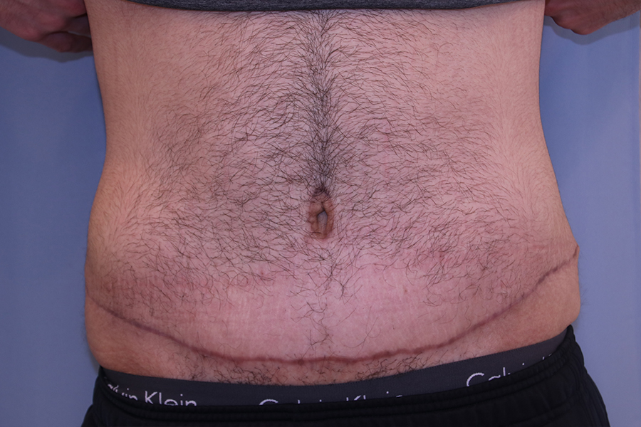 Tummy Tuck Before and After 01