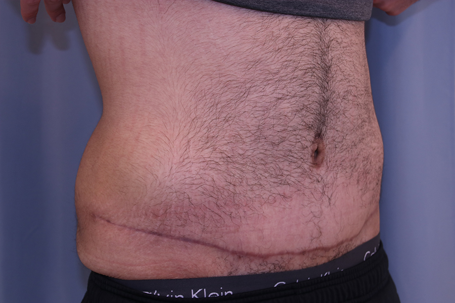 Tummy Tuck Before and After 01