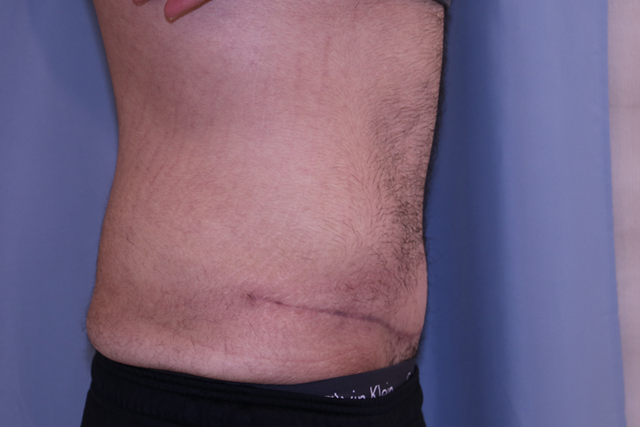 Tummy Tuck Before and After 01